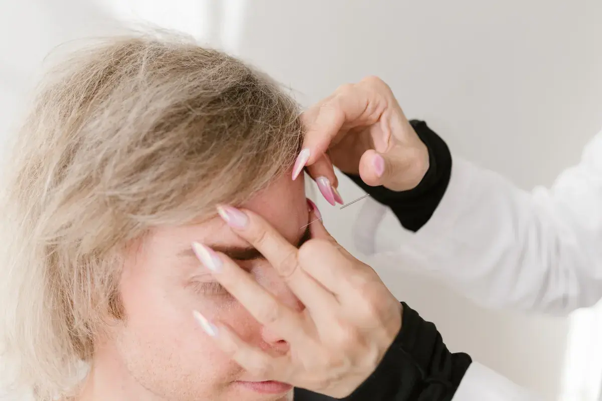 Hands inserting a thin needle near someone's ear during a treatment session