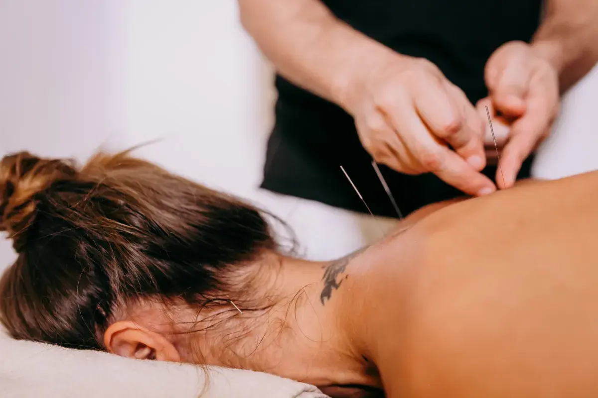 Acupuncture needles being inserted into a person's back during treatment