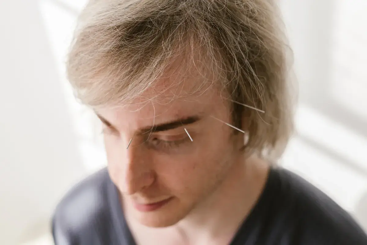 Person with acupuncture needles inserted on the face and forehead during treatment