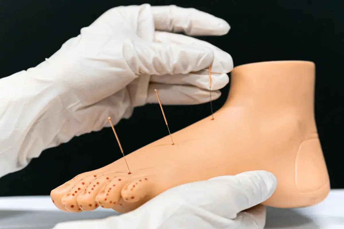Gloved hands inserting thin needles into a model foot with marked acupuncture points against a black background