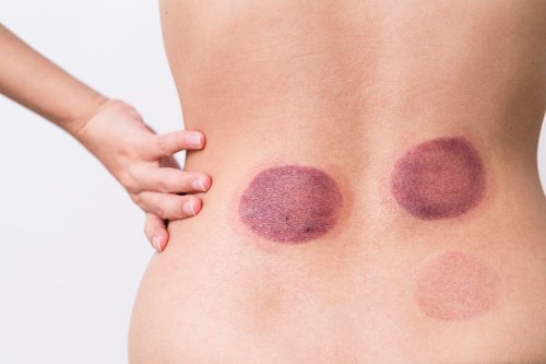 Round cupping marks on a person’s lower back