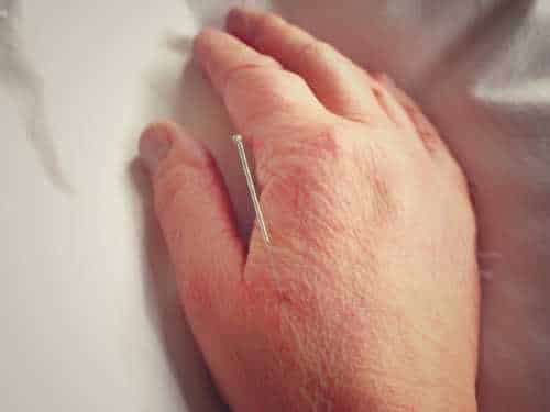 Georgina Ontario Acupuncture