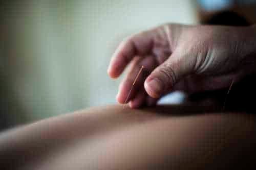 Newmarket Acupuncture