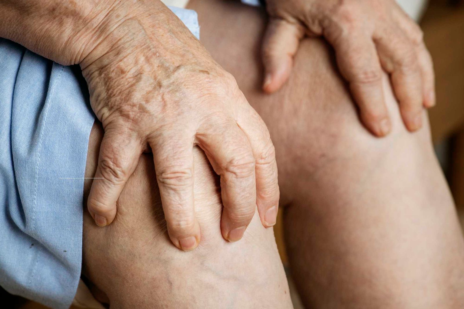 Elderly woman holding their knees before getting knee acupuncture in keswick