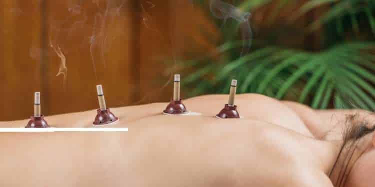 Moxibustion cones burning on a person’s back