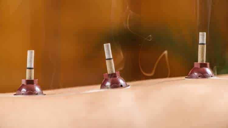 Moxibustion cones on stands along a person’s back