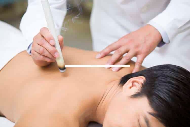 Practitioner holding a moxa stick above a patient’s back