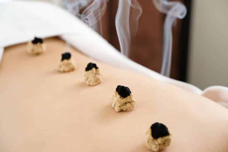 Small moxa cones burning on a person’s back