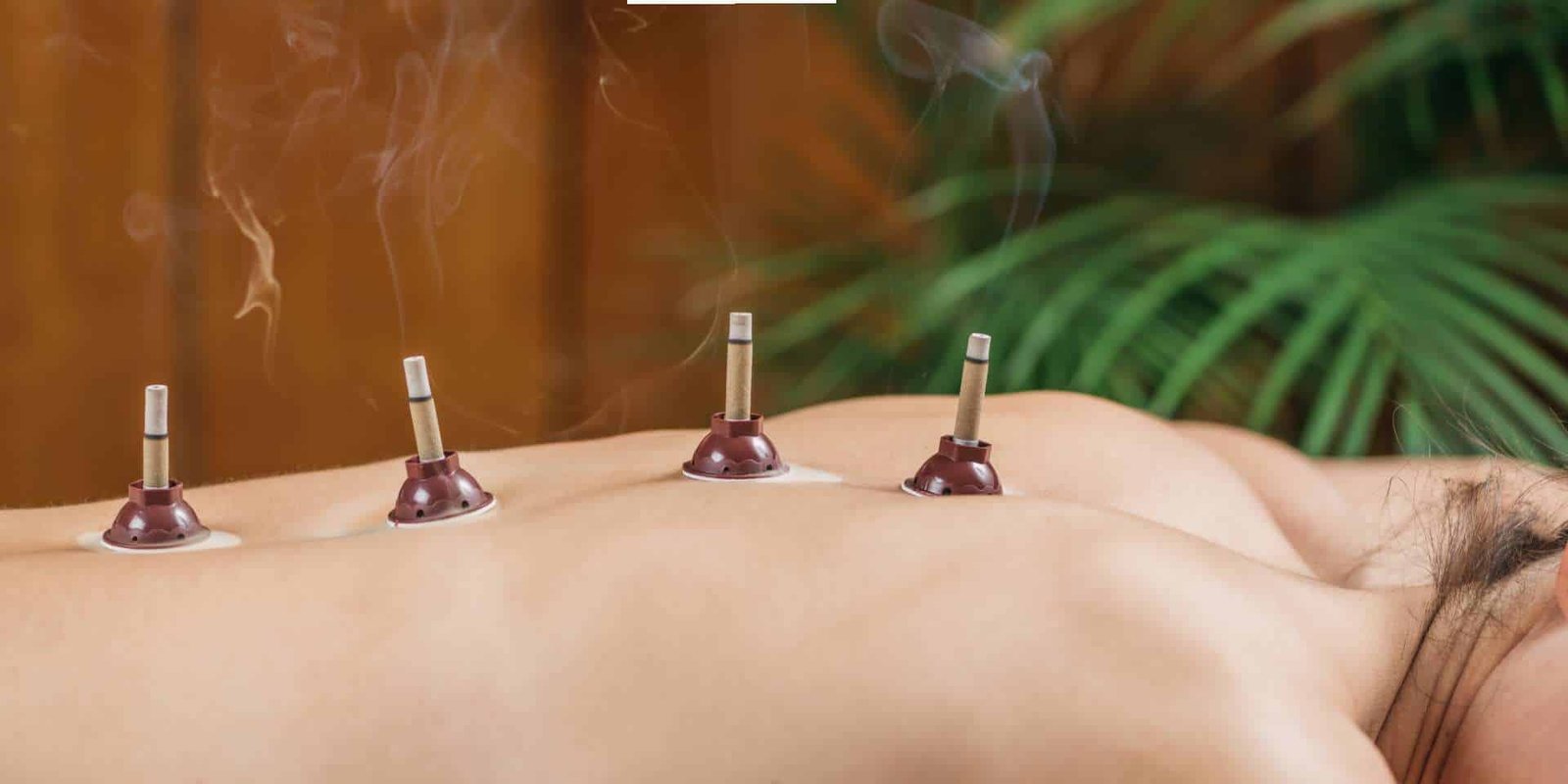 Moxibustion cones burning along a person’s back