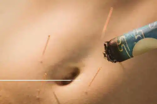 Acupuncture 4