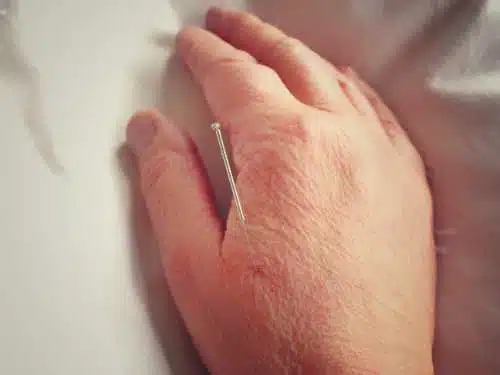 Georgina Ontario Acupuncture