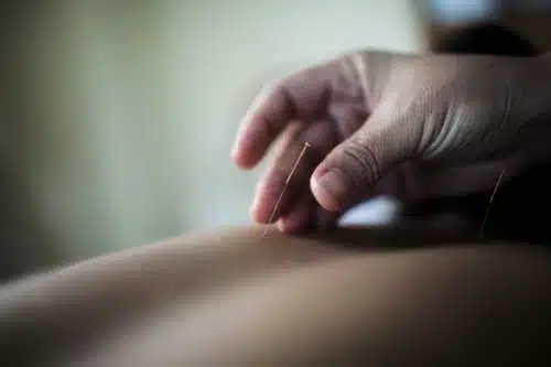 Keswick Acupuncture Clinic, Feel Better Naturally 3 Newmarket Acupuncture