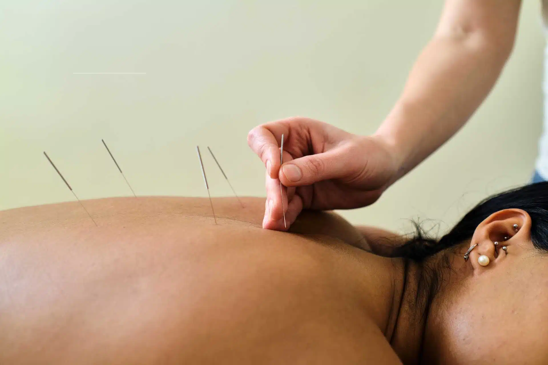 Keswick Acupuncture Clinic, Feel Better Naturally 4 East Gwillimbury Acupuncture