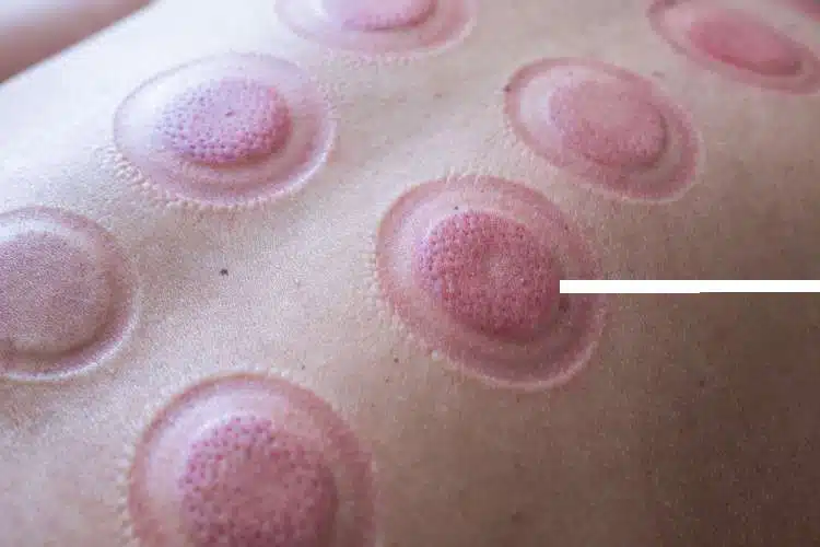 Cupping 4